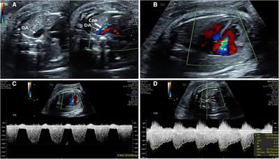 Evaluation of changes of cardiac morphology and function in fetuses with ductus arteriosus constriction by Speckle-tracking echocardiography